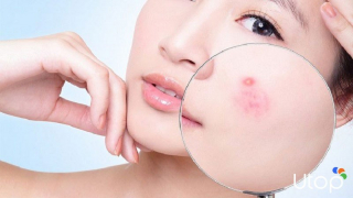 Cách đẩy lùi mụn nhanh nhất vào ngày hè an toàn không cần mỹ phẩm