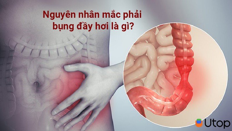 Nguyên nhân mắc phải bụng bị đầy hơi