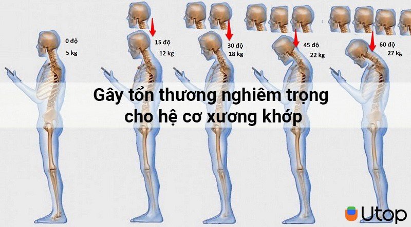 Gây tổn thương nghiêm trọng cho hệ cơ xương khớp