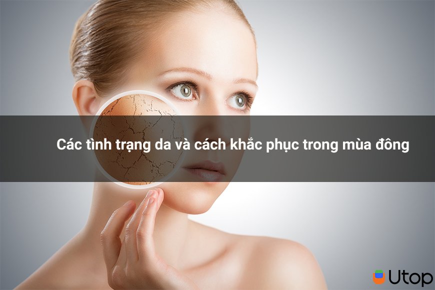 Các tình trạng da gặp phải trong mùa đông. Cách khắc phục