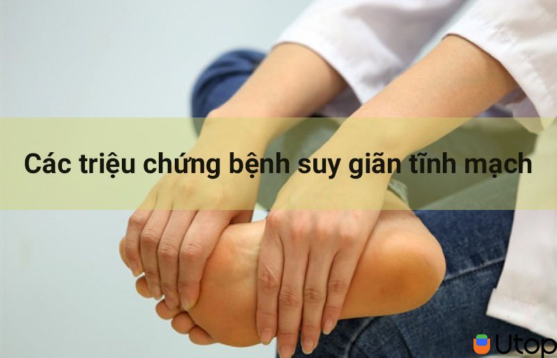 Bệnh suy giãn tĩnh mạch có các triệu chứng nhận biết như thế nào?