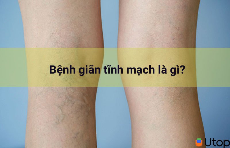 Bệnh giãn tĩnh mạch là gì? Các triệu chứng và nguyên nhân