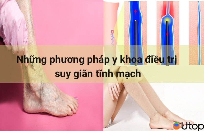 Những phương pháp hiệu quả điều trị suy giãn tĩnh mạch