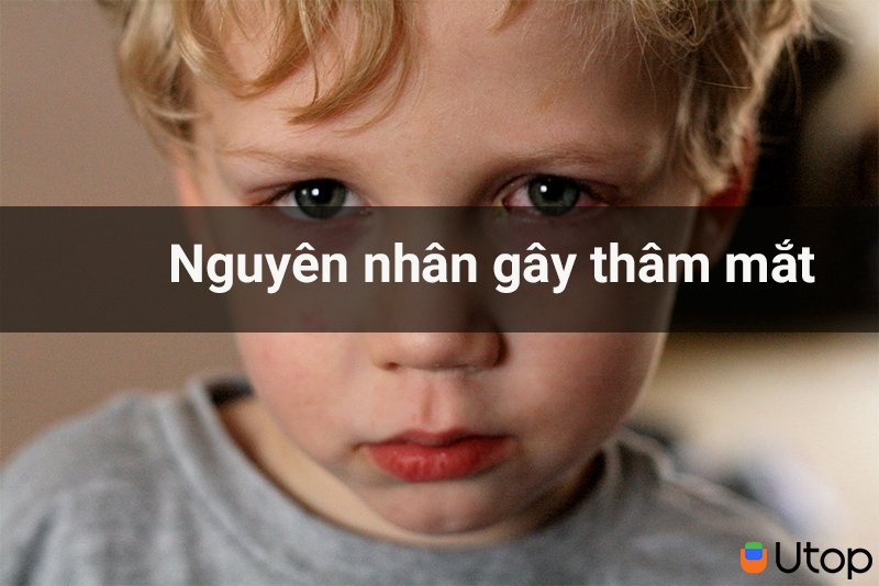 Nguyên nhân nào gây thâm mắt