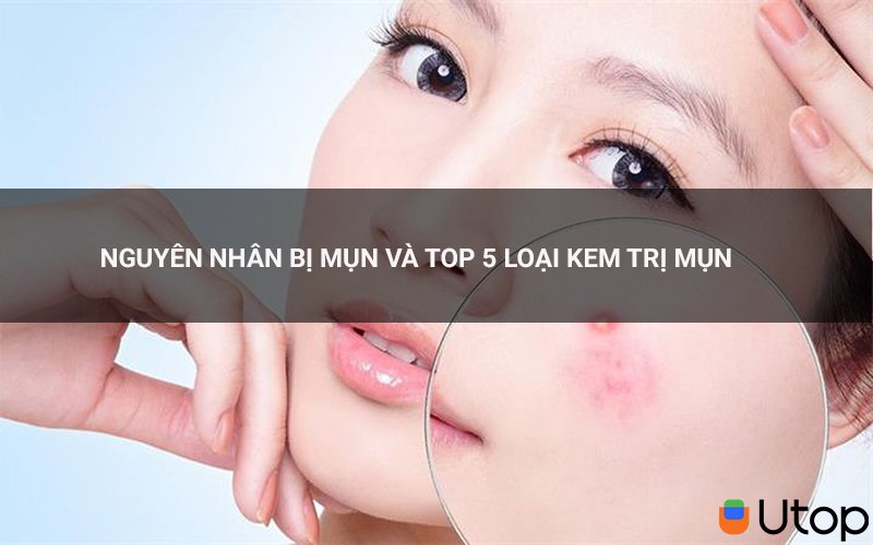 Tại sao lại bị mụn? Top 5 loại kem trị mụn an toàn hiệu quả