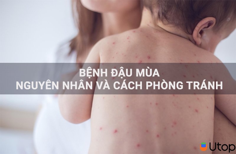 Bệnh đậu mùa - nguyên nhân và cách phòng tránh hiệu quả