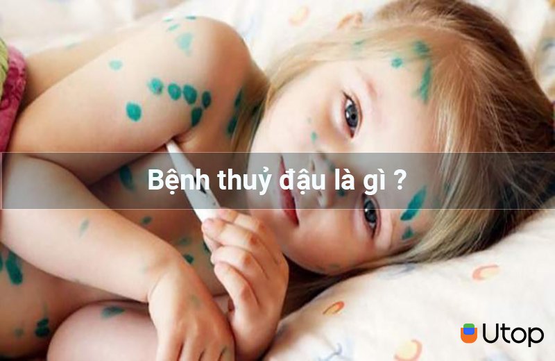 Bệnh thuỷ đậu là gì ?