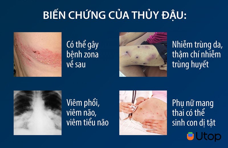 Biến chứng của bệnh thuỷ đậu