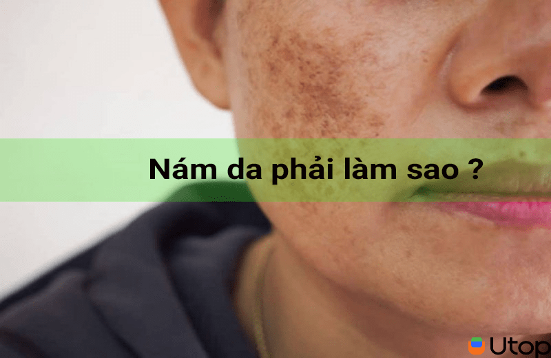 Bị nám da phải làm sao? 99% chị em hiểu sai về cách trị nám