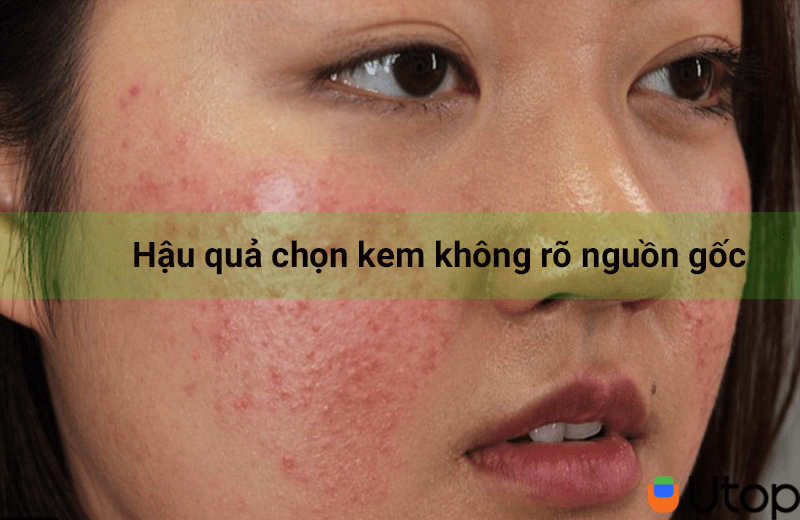 Bị nám da phải làm sao?