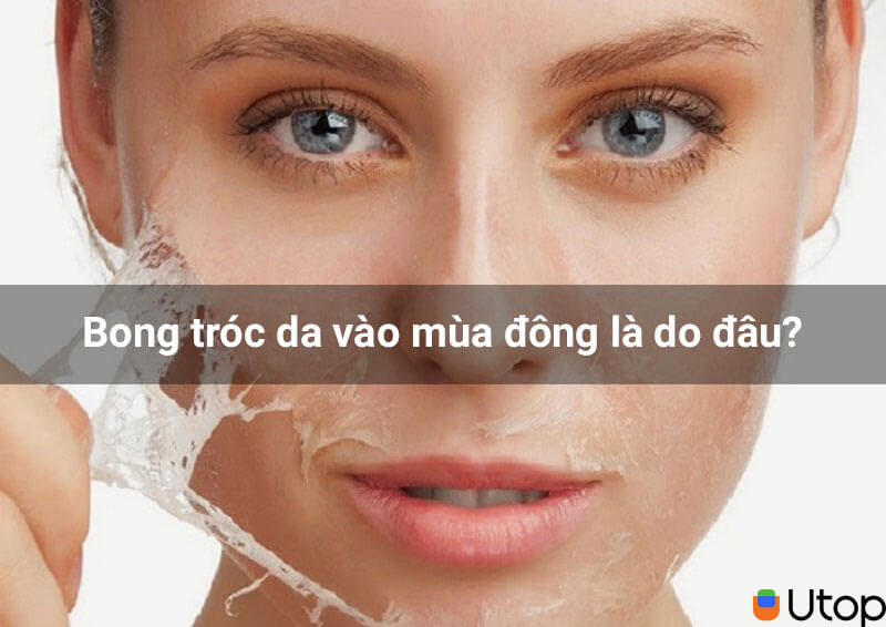 Bong tróc da vào mùa đông là do đâu?