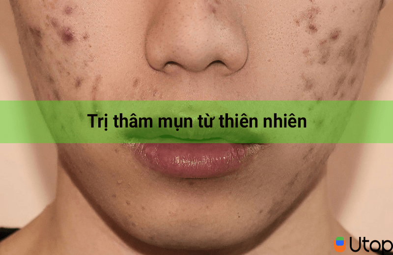 Cách trị thâm mụn hiệu quả từ thiên nhiên chỉ sau 2 tuần