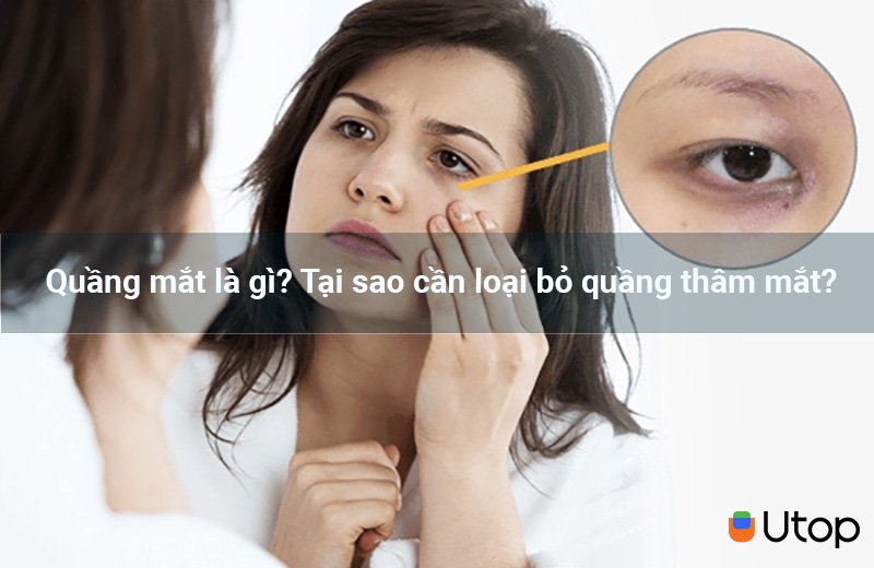 Quầng mắt là gì? Tại sao cần loại bỏ quầng thâm mắt?