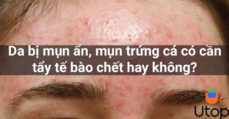 Da bị mụn ẩn, mụn trứng cá có cần tẩy tế bào chết hay không?