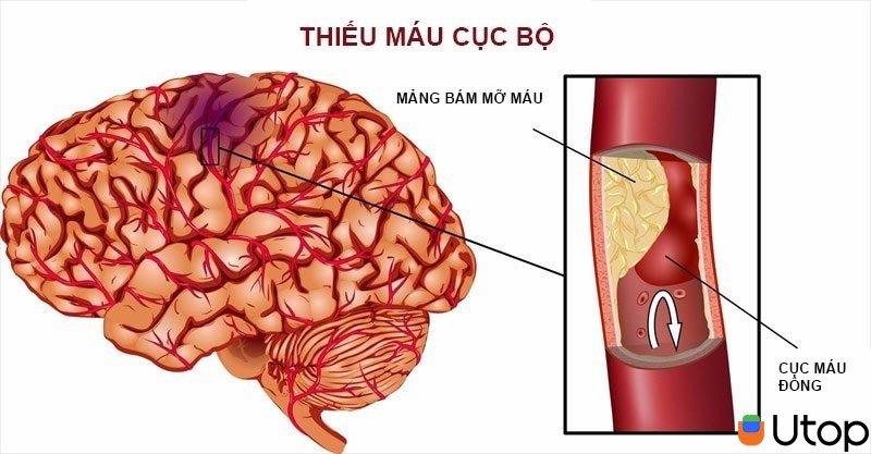 Đột quỵ do thiếu máu cục bộ