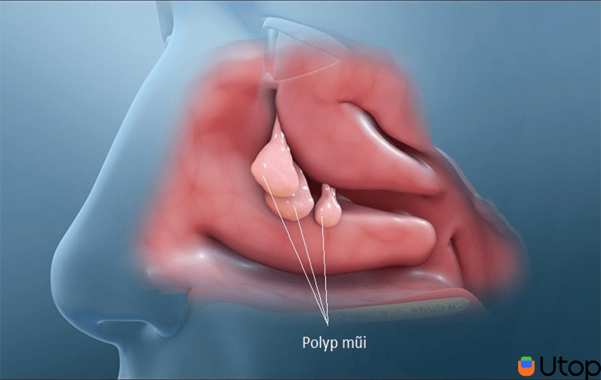 Bệnh viêm xoang là gì?