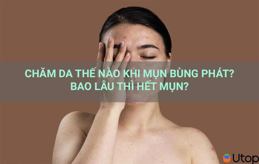 CHĂM DA THẾ NÀO KHI MỤN BÙNG PHÁT? BAO L U THÌ HẾT MỤN