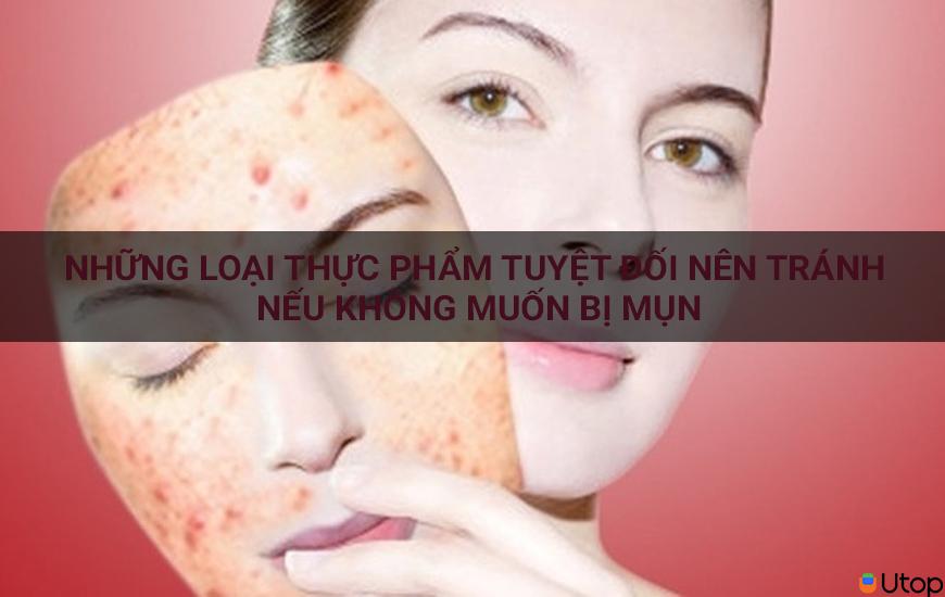 Những thực phẩm tuyệt đối nên tránh nếu như không muốn bị mụn