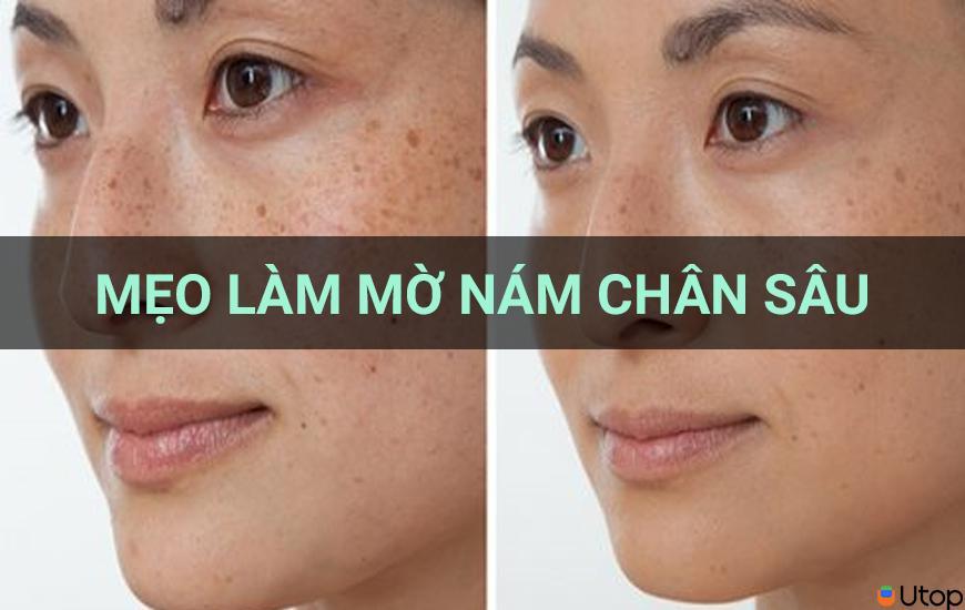 Mẹo làm mờ nám chân sâu chị em không nên bỏ lỡ