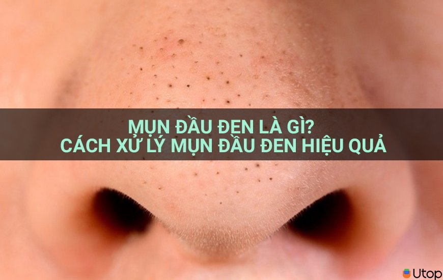 Mụn đầu đen là gì? Cách xử lý mụn đầu đen hiệu quả