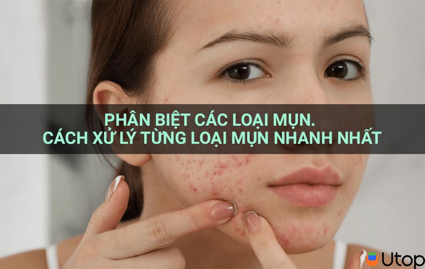 Phân biệt các loại mụn. Cách xử lý từng loại mụn nhanh nhất