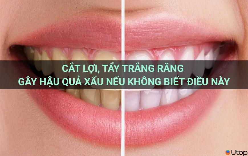 Cắt lợi, tẩy trắng răng gây hậu quả xấu nếu không biết điều này