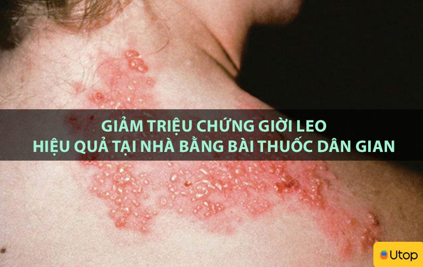 Giảm triệu chứng giời leo hiệu quả tại nhà bằng bài thuốc dân gian