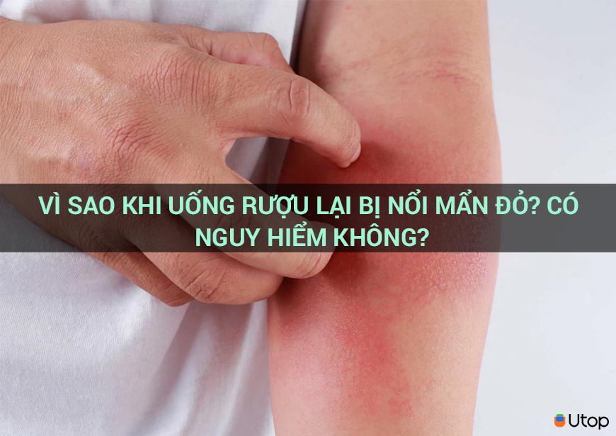 VÌ SAO KHI UỐNG RƯỢU LẠI BỊ NỔI MẨN ĐỎ? CÓ NGUY HIỂM KHÔNG?