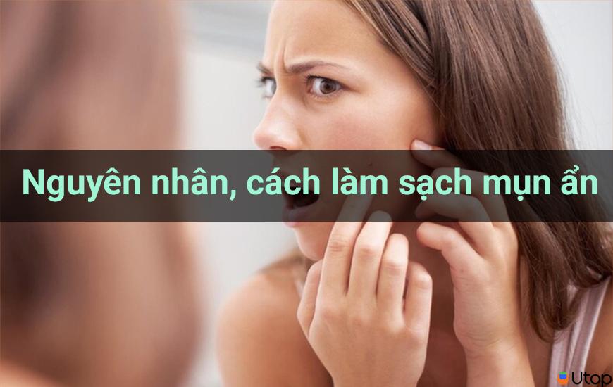 Nguyên nhân gây mụn ẩn? Cách làm sạch mụn ẩn hiệu quả cho nàng bỏ túi