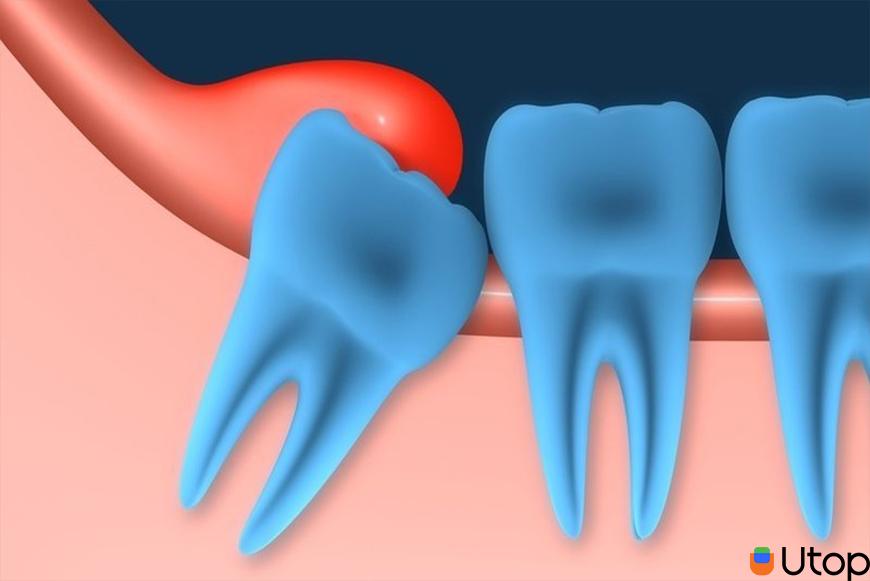 Cắt lợi là gì? Vì sao phải cắt lợi