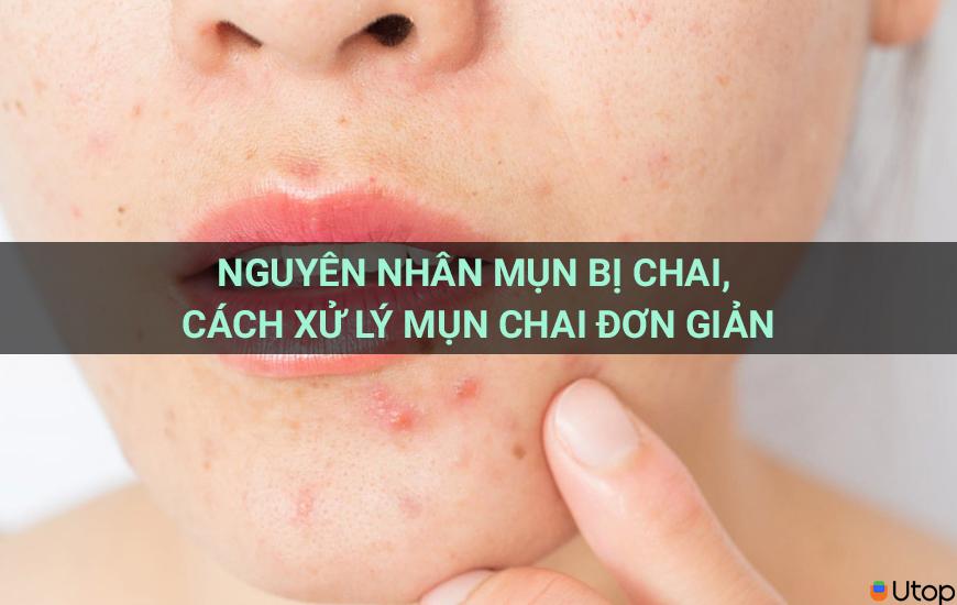 Nguyên nhân mụn bị chai, cách xử lý mụn chai đơn giản