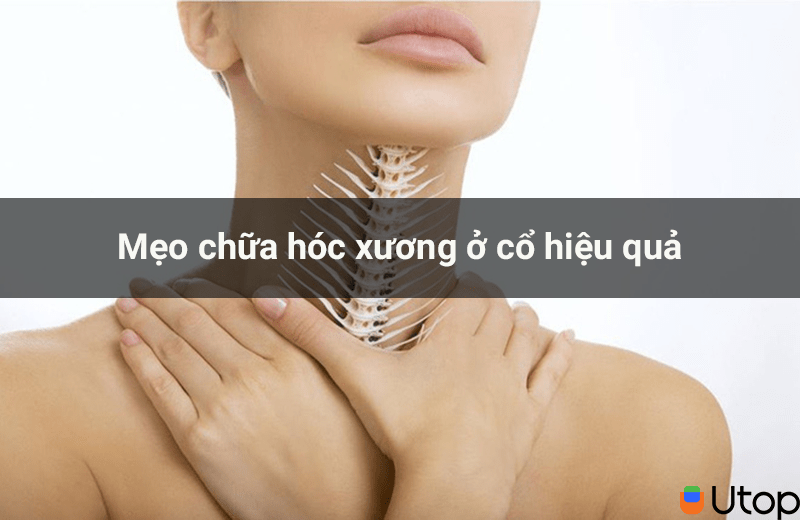 Mẹo chữa hóc xương ở cổ hiệu quả và nhanh chóng cho bạn