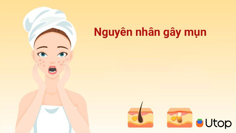 Nguyên nhân gây mụn