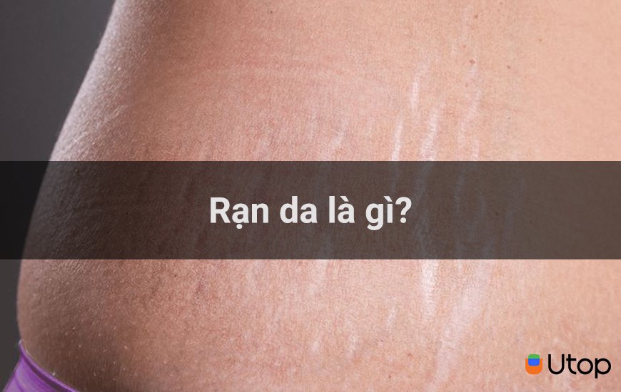 Rạn da là gì?