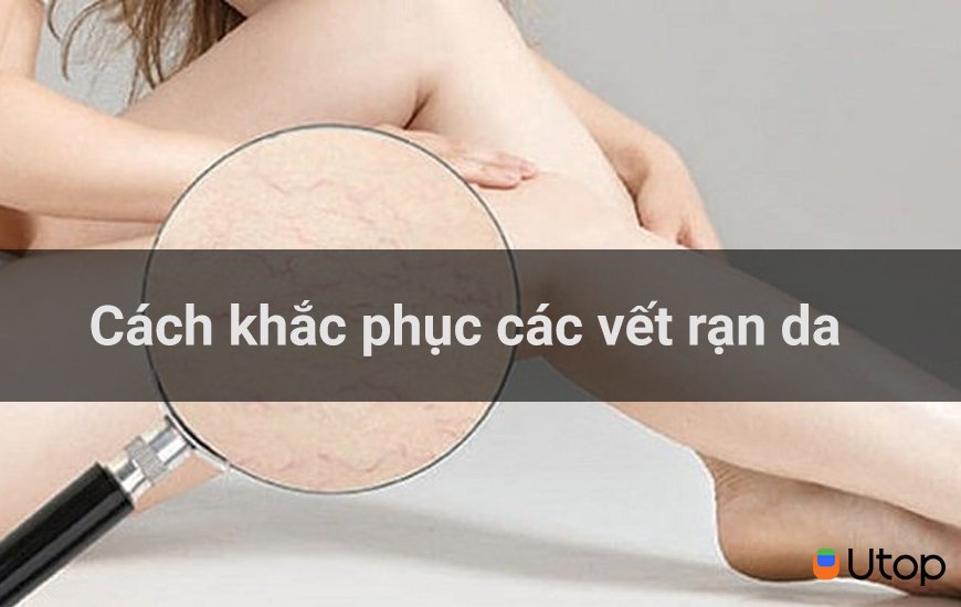 Cách khắc phục các vết rạn da?