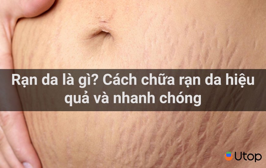 Rạn da là gì? Cách chữa rạn da hiệu quả và nhanh chóng