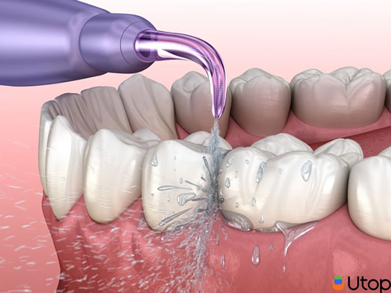 Ai có thể sử dụng tăm nước? Sử dụng tăm nước có làm lỡ lợi hay không?