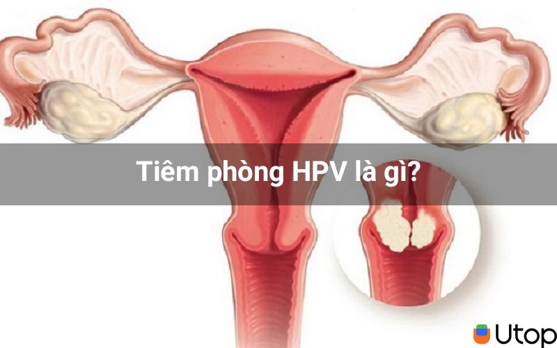 Tiêm phòng HPV là gì?