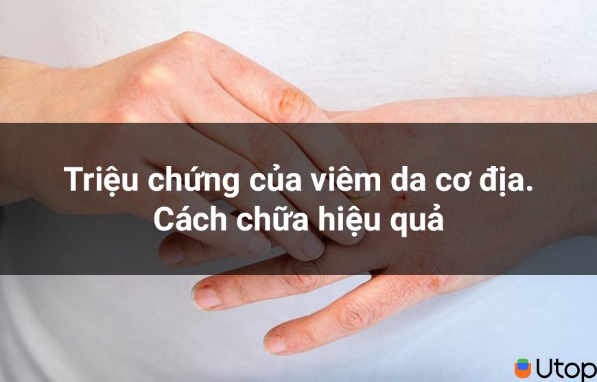 Triệu chứng của viêm da cơ địa - Cách chữa hiệu quả nhất