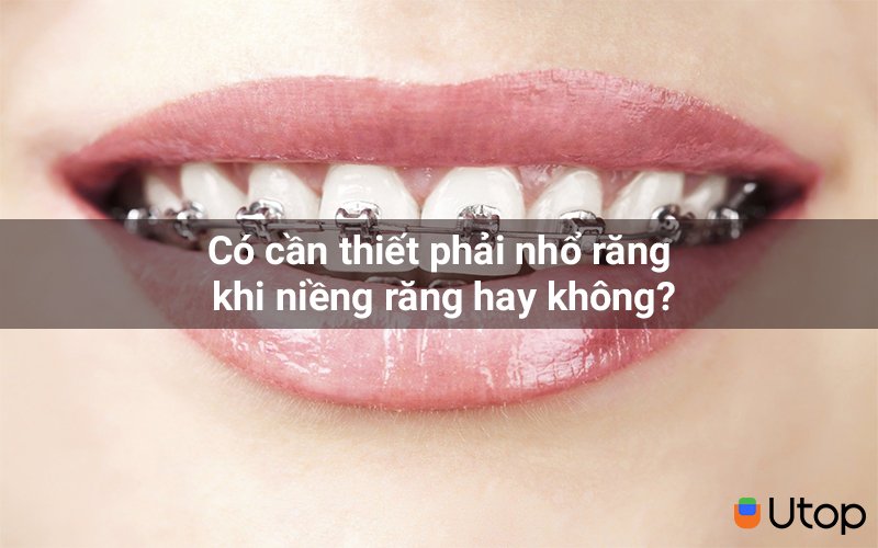 Có cần thiết phải nhổ răng khi niềng răng hay không?