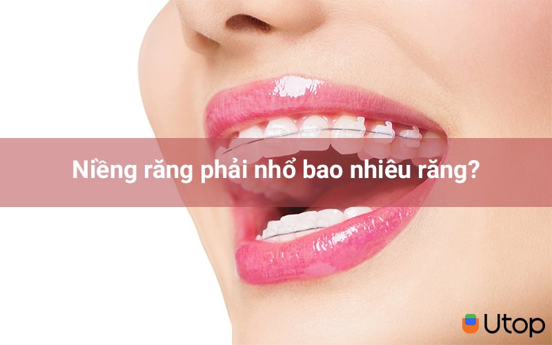 Nếu có thì phải nhổ bao nhiêu răng?