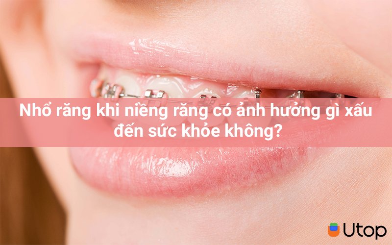 Nhổ răng khi niềng răng có ảnh hưởng gì xấu đến sức khỏe không?