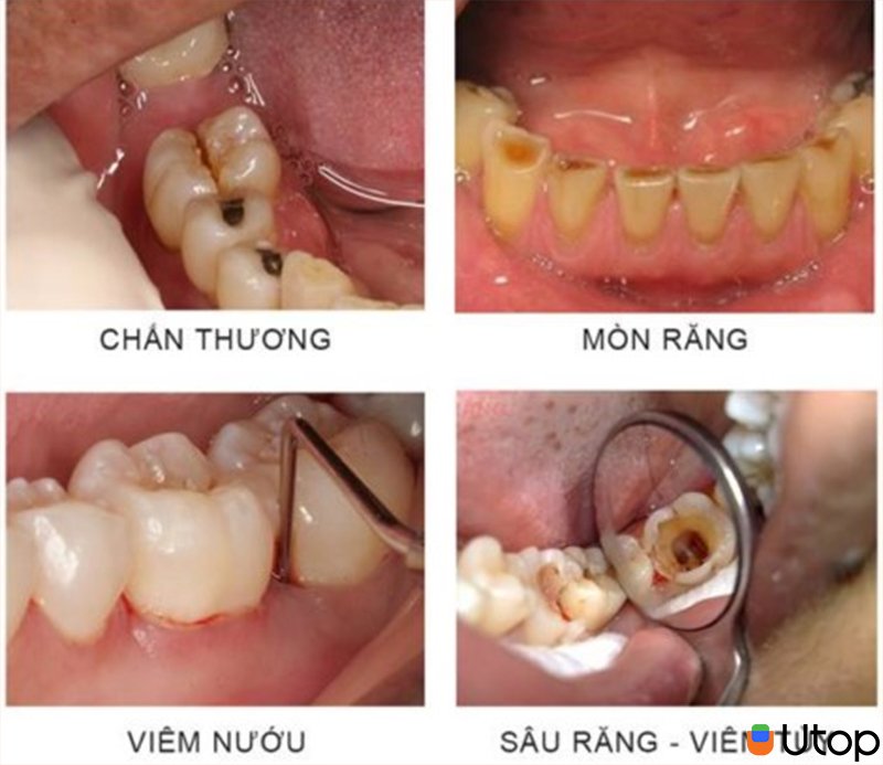 Các bệnh lý về răng