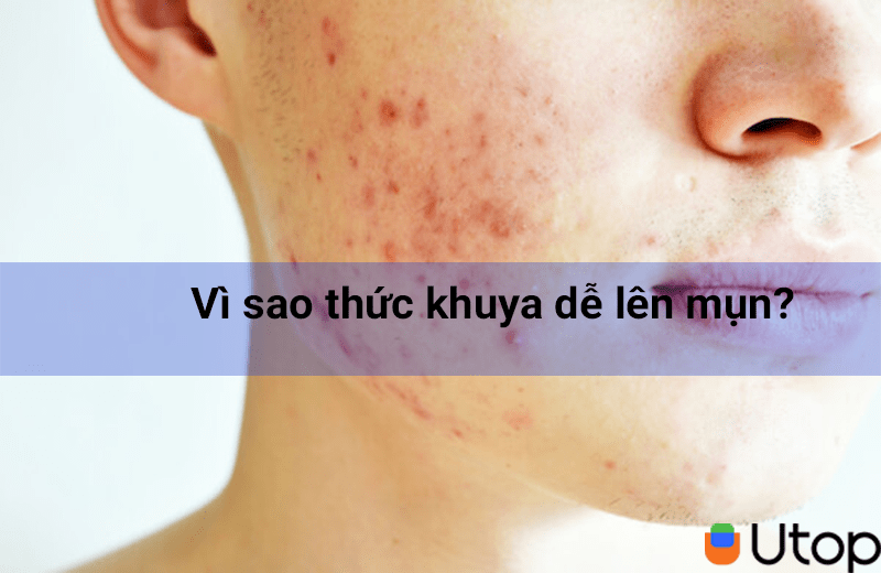 Vì sao thức khuya dễ lên mụn? Cách chăm sóc da mụn đơn giản