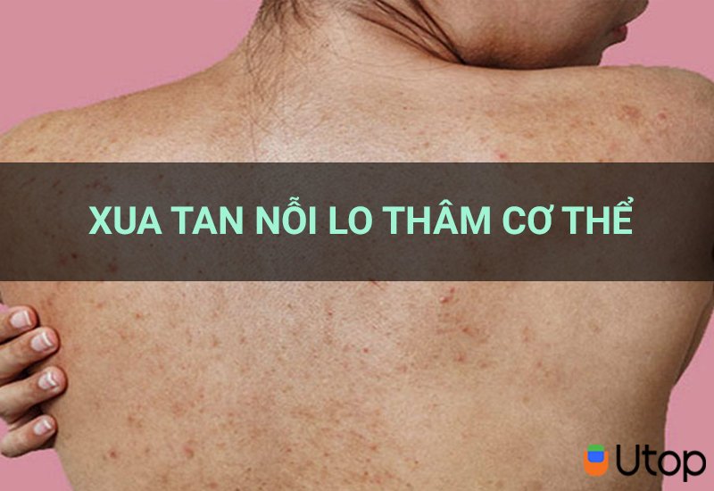 Xua tan nỗi lo thâm cơ thể nhờ top 6 mẹo trị thâm này